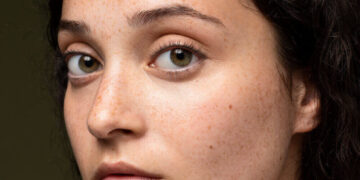 Mujer con manchas en la piel